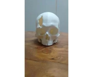 Cráneo Con Fractura En Hueso Frontal Tomografía Computada. 3D Models